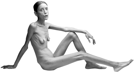 Фото анорексия голые